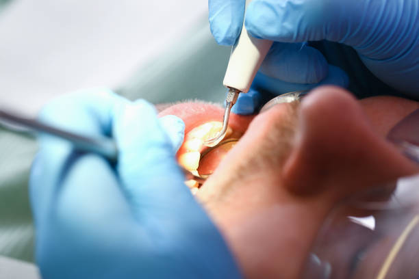 Best Emergency Tooth Extraction in River Road, WA